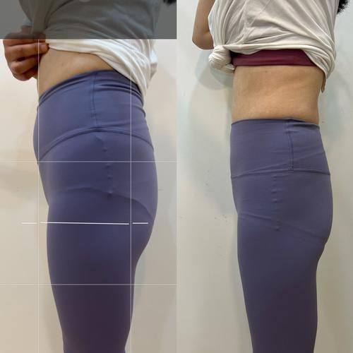 柳州艾尚美整形真人口碑评价怎么样？