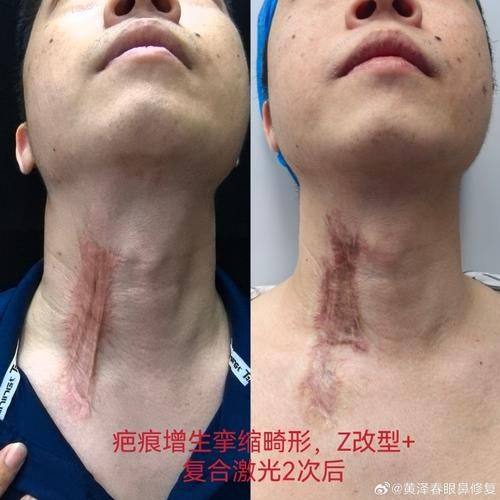 驻马店华美医疗美容医院真人口碑评价怎么样？