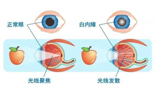 山西阳泉爱维视医疗详细的预约挂号方式及流程