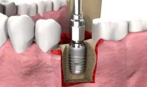 湖州德清武康沈云祥牙科诊所真人口碑评价怎么样？