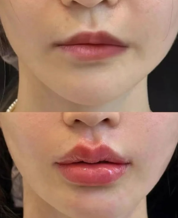 六安伊而美整形美容真人口碑评价怎么样？