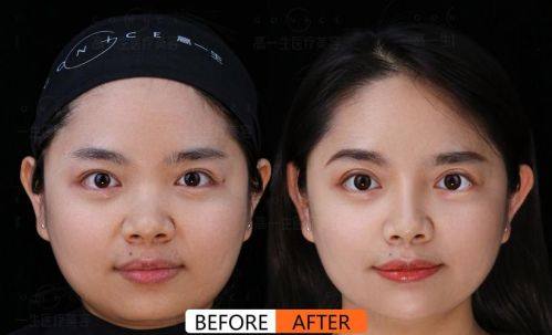 惠州芝华整形医院真人口碑评价怎么样？