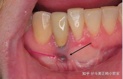 侯露医生技术优势