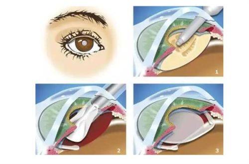 乳山新视力眼科医院真人口碑评价怎么样?