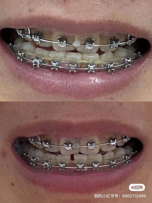 山东德州禹城爱华口腔真人口碑评价怎么样？