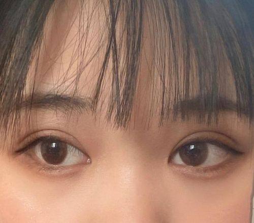 杭州亿咖整形医院真人口碑评价怎么样？