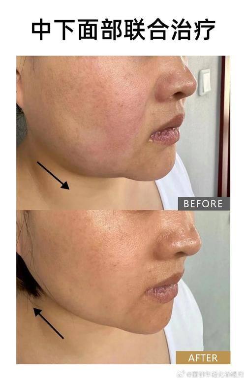 韩国百利酷整形外科真人口碑评价怎么样？