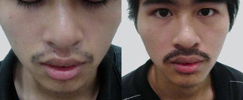 武汉大麦植发医院(原科发源)收费价格表/收费标准