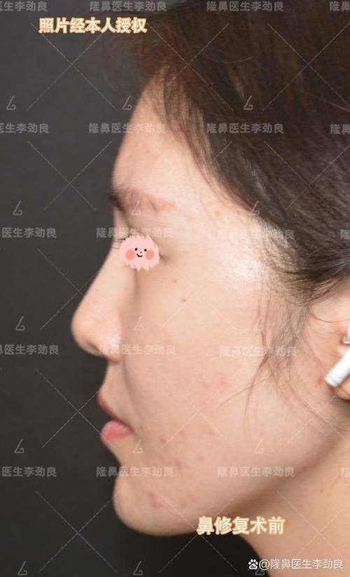 台州新(金)凤凰整形美容医院真人口碑评价怎么样？