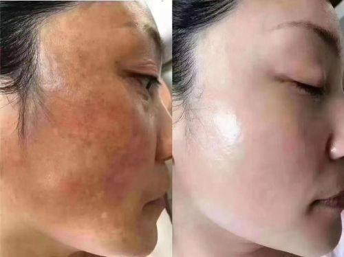 义乌玺颜整形医院治疗反馈与口碑评价。